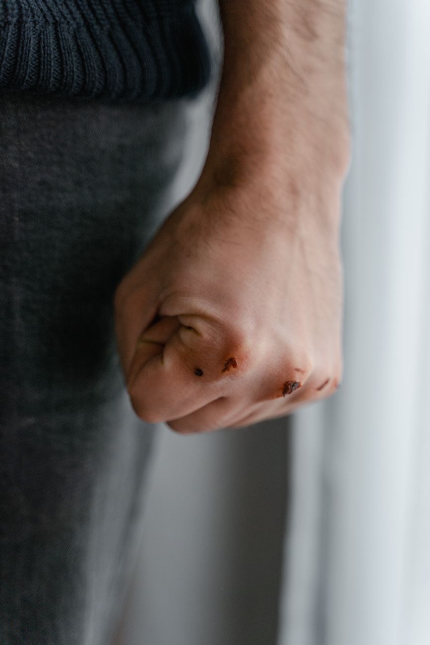 close up shot of wound on a person s hand